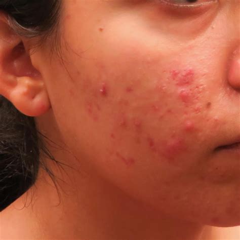 Dr. Pimple Popper Reveals the Acne You Shouldn't Pop | Reader's Digest