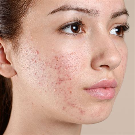 Acne and Acne Scarring Treatments | Face Teeth Smile | Gerrards Cross