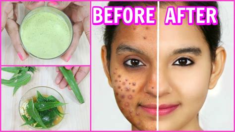 How To Get Rid Of My Pimples On My Face at Rita Pinkerton blog