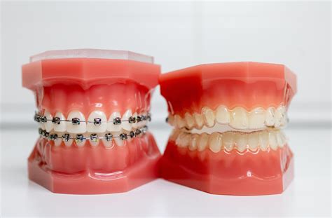 Benefits of Teeth Alignment Options: Braces & Invisalign