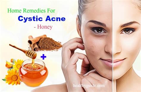 18 Best Home Remedies for Cystic Acne On Face, Neck, Nose, Cheek, Forehead