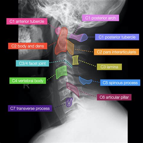 Cervical Spine Anatomy Radiology Anatomy Part 1 Prep C Spine X Ray ...