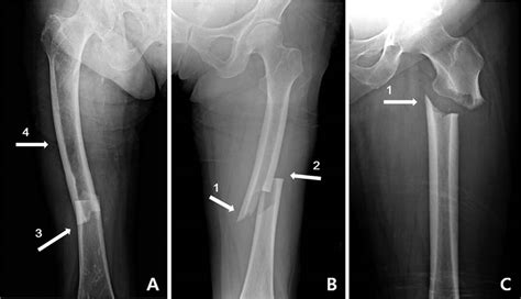 Broken femur types, causes, treatment, recovery time & complications