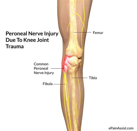 Peroneal Nerve Injury - Treatment, Causes, Symptoms