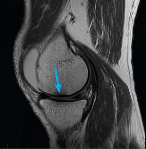 mri-knee-meniscus-tear - MRI at Melbourne Radiology Clinic