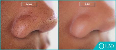 Blackheads On Nose: Removal Treatments, Cost And Results