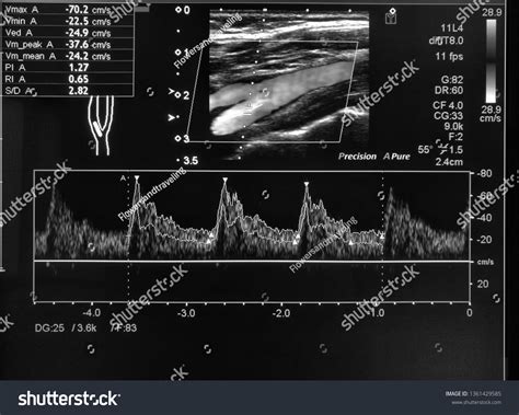 Doppler Ultrasound Normal Carotid Artery Stock Photo (Edit Now) 1361429585