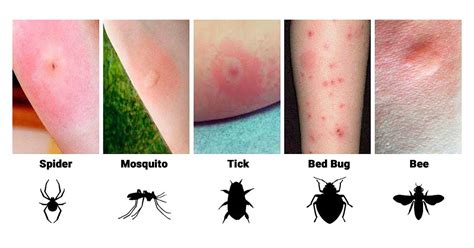 Spider bites – nhện cắn – Việt Bách