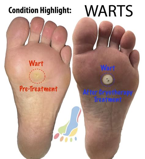 Plantar Wart Gone at Robert Mills blog