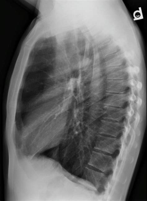 Emphysema – Undergraduate Diagnostic Imaging Fundamentals