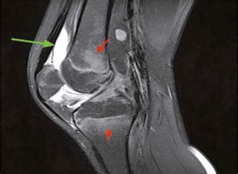 Magnetic resonance imaging of the knee joint in juvenile idiopathic ...