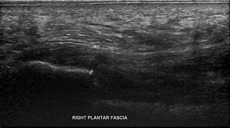 Normal Plantar Fascia Thickness Ultrasound