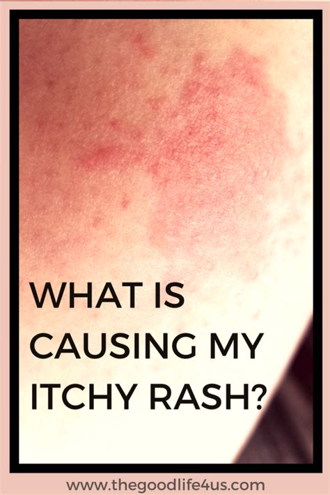 Identify Different Types Of Skin Rashes And Causes Skin 4 Cares ...