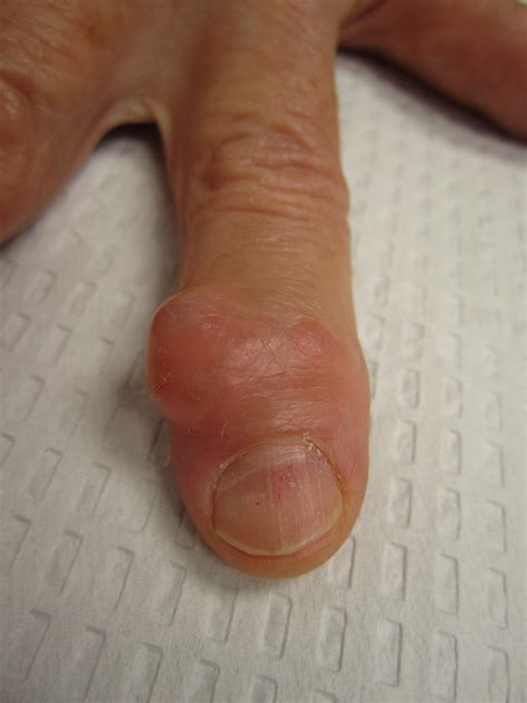 Synovial Cyst Finger Joint