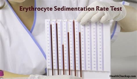 Erythrocyte Sedimentation Rate Results & Procedure | Health Checkup