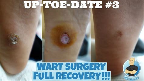 Plantar Wart Images After Removal