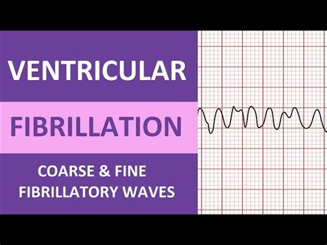 Ventricular Fibrillation (V-Fib) ECG Interpretation Nursing Heart ...