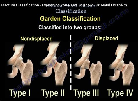 Femoral Neck fracture classification — OrthopaedicPrinciples.com