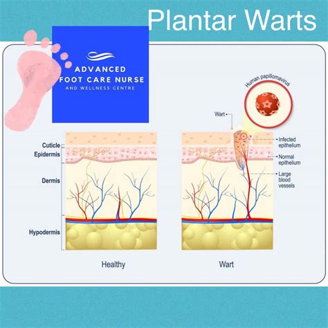 Anatomy Of A Plantar Wart