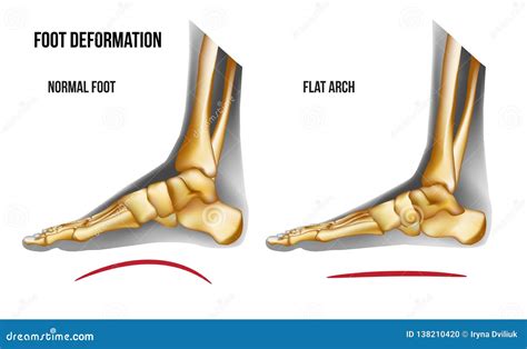 Anatomy Flat Foot Arch Medial View Stock Vector - Illustration of ...