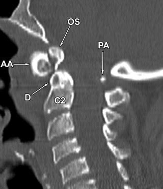 Os Odontoideum | Radiology Key