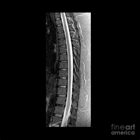 Sagittal Mri Of Normal Thoracic Spine Photograph by Medical Body Scans