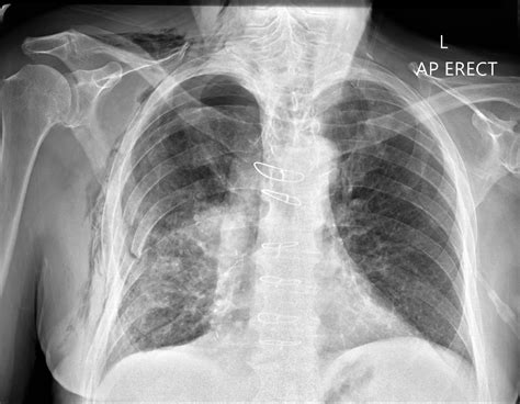 Subcutaneous Emphysema | Test Findings - MedSchool