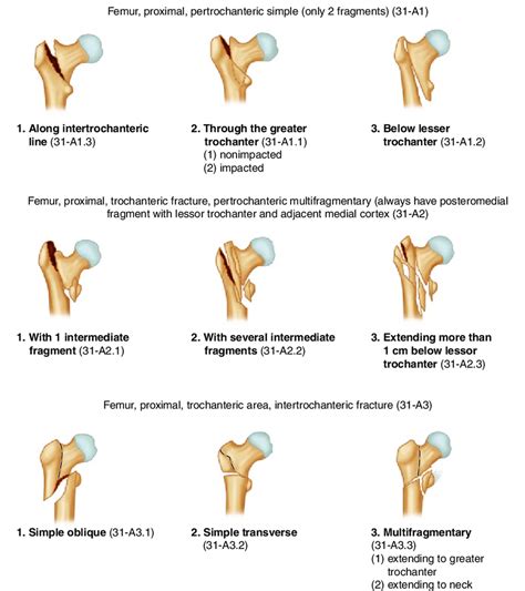 Ao Ota Fracture Classification Of Proximal Femur Trochanteric Region ...