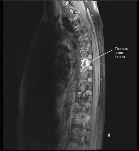 Abnormal Thoracic Mri