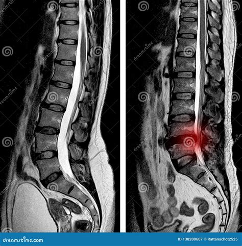 MRI Scan Sagittal View Lumbosacral Spine Has Straightening Lumbar ...