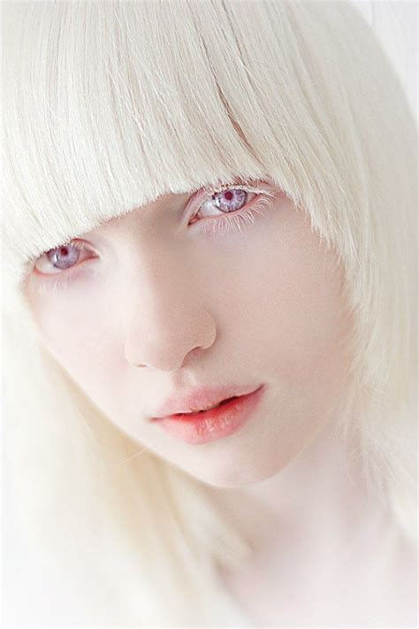 Nastya Kumarova #albino #albinism Willow has albinism and because of ...