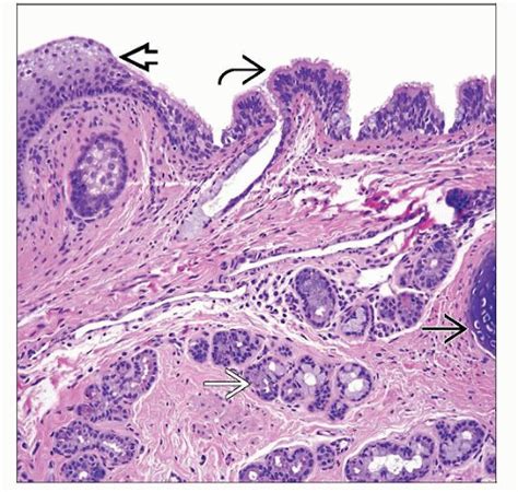 Immature Teratoma Histology