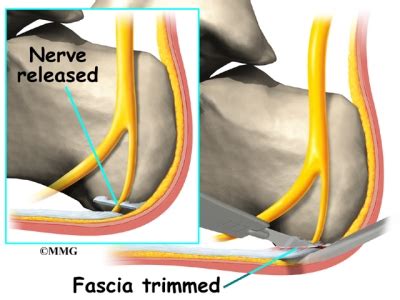 Photo Scanner: Plantar Fasciitis Surgery