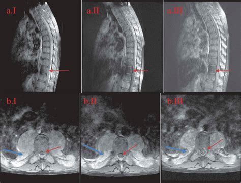 Thoracic Spine Mri Anatomy