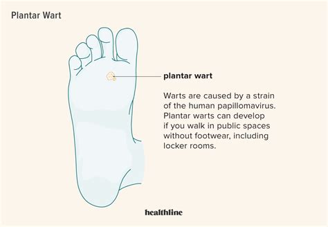 Plantar Wart: What is it, Symptoms, Treatment, and More