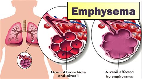 IMC | Emphysema - Symptoms And Causes