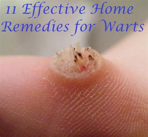 infected plantar wart - pictures, photos