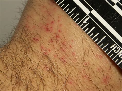 What Do Bed Bugs Bites Look Like? Pictures of Bed Bug Bites - PestGuide.org