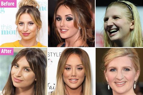 The best and worst celebrity nose jobs, from Ferne McCann to Rebecca ...