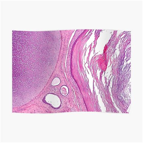 "Teratoma Histology" Poster for Sale by deltoid | Redbubble