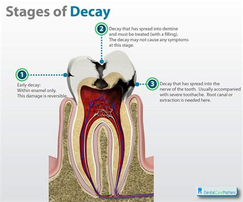 Tooth decay signs from your Redcliffe Dentist - John Street Dental ...