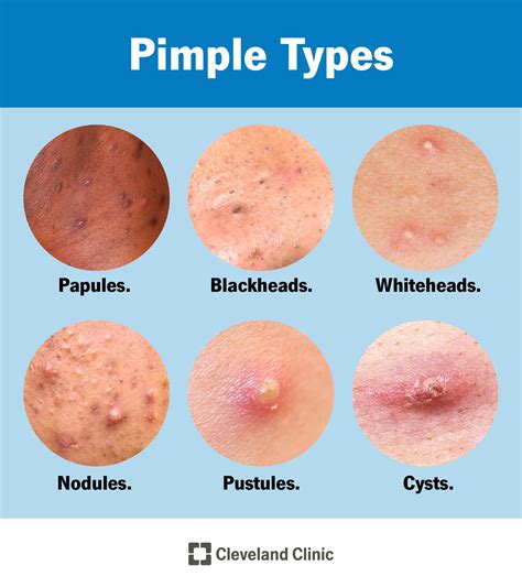 Pimples: Causes vs. Acne, Types & Treatment