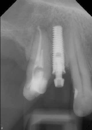 Dental X-ray after dental implantation. | Download Scientific Diagram