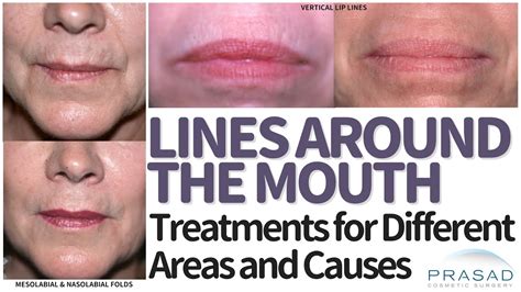 Laser Treatment For Wrinkles Around Mouth - Quotes Type