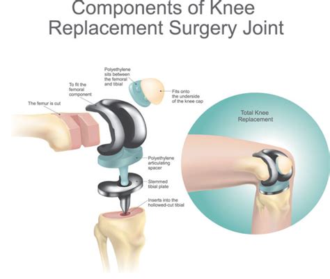 Knee Replacement Surgery (Total Knee Arthroplasty) - Schulze Orthopedics