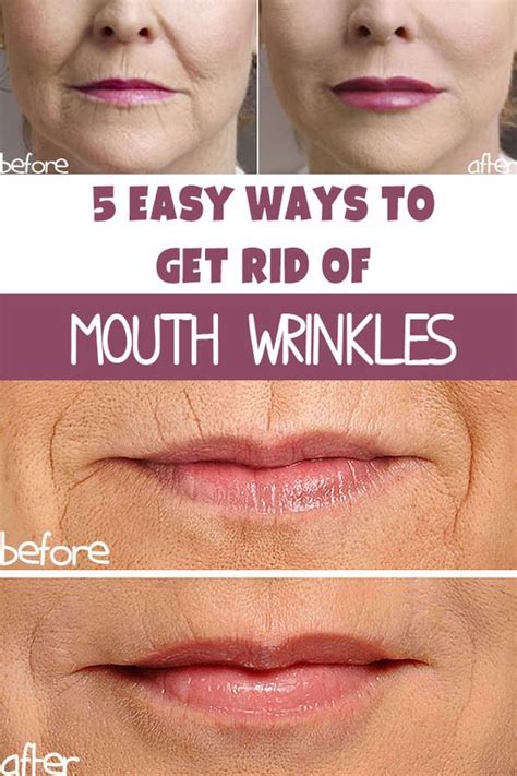 5 WAYS TO GET RID OF WRINKLES AROUND THE MOUTH | HEALTHYTIPS