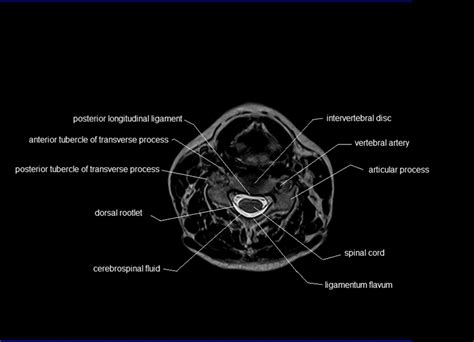 MRI Spine Anatomy | Free MRI Axial Cervical Spine Anatomy