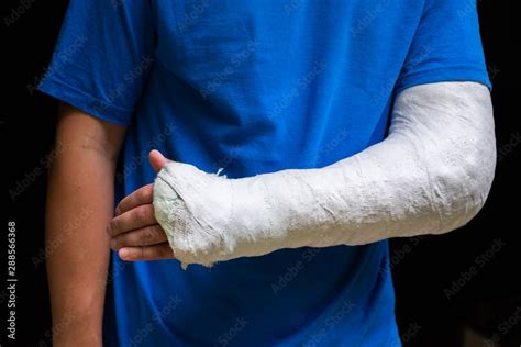 Man with broken arm wrapped medical cast plaster. Fiberglass cast ...