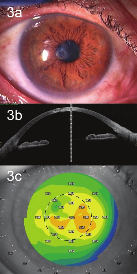 Postoperative images of paracentral corneal perforation. a) The corneal ...