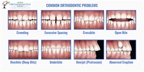 Different Types Of Bite Alignment And Treatment - Miami Orthodontist Group